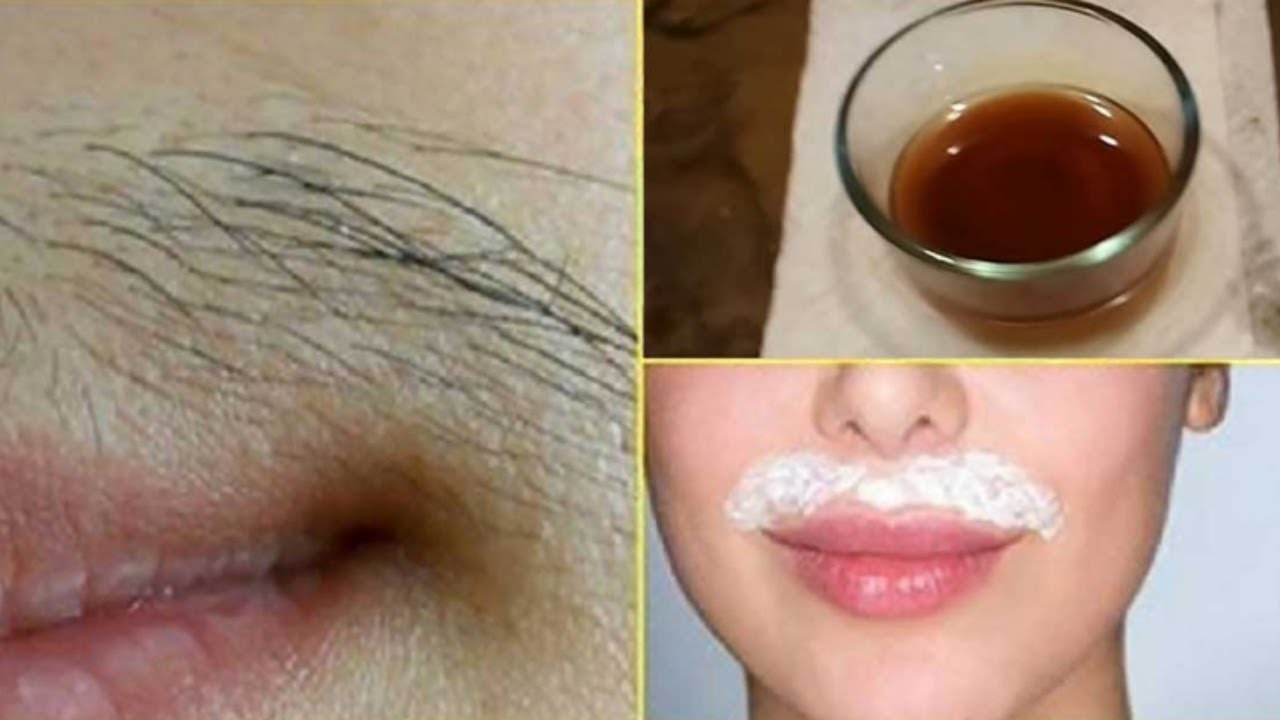 Women facial hair removal insurance coverage