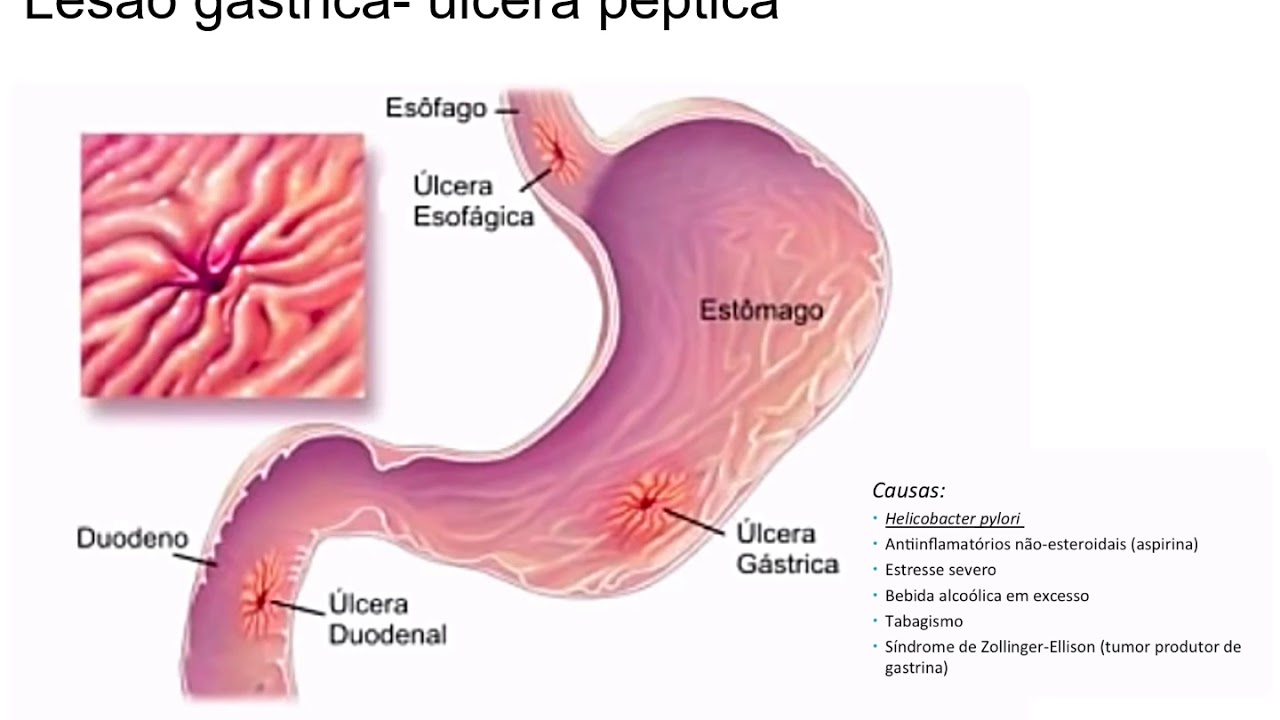 Sintomas de ulcera anal