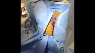 Before And After Video Of Labiaplasty Procedure