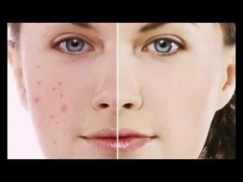 Hướng dẫn tự làm kem trị mụn tại nhà.