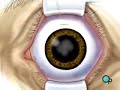 PreOp® Patient Education: Cataract Small Incision Eye pt.1