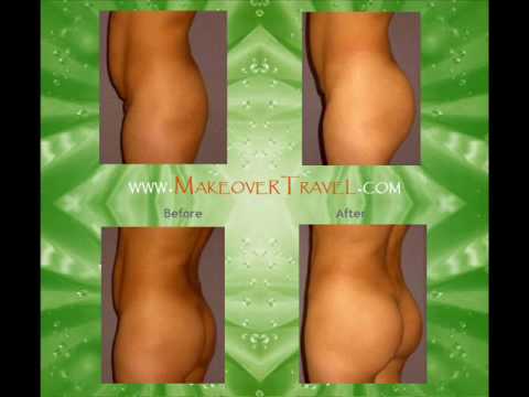 buttock augmentation with fat injection before and after pictures. buttock augmentation with fat injection before and after pictures.