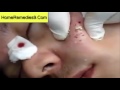 Extreme Case Of Acne    Treated By Laser And Pus Fly   Acne Treatment   YouTube