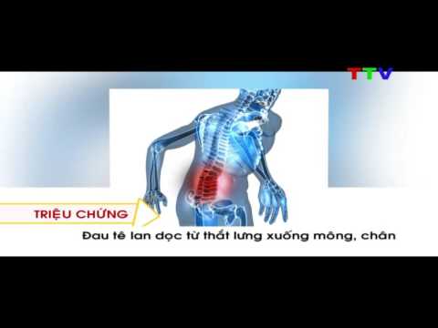 Thoát vị đĩa đệm ở người trẻ tuổi