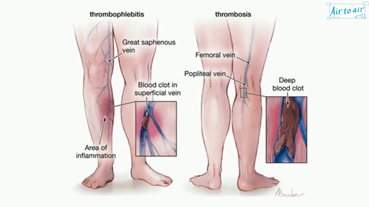 Deep vein thrombosis penis