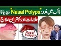 Gadood in Nose OR Nasal Polyps - Symptoms and Treatment of Nasal Polyps - Nose Polyps Ka ilaj