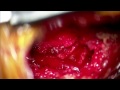 Dan Dobi ACTUAL Back Surgery Video - Microdiscectomy