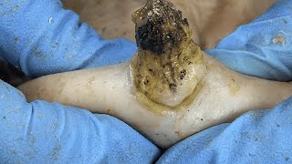 Asmr Satisfying Relaxing Ultimate Pedicure & Ear Cleaning Dr Lees Pimple Popper 0910M2 0517