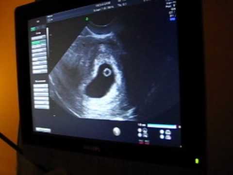 sonogram 5 weeks. First Ultrasound at 6 weeks 3