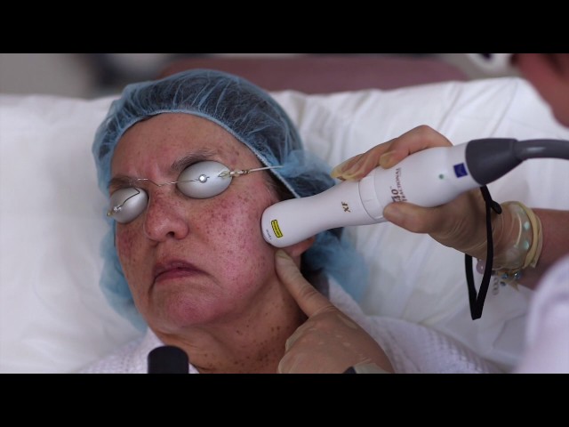 Palomar Icon Laser