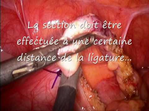 Ruptured Ovarian Cyst Ruptured Ovarian Cyst. Ruptured Ovarian Cyst