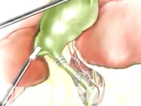 gallbladder removal through belly button. PreOp® Patient Education Gallbladder Removal Hassan Surgery