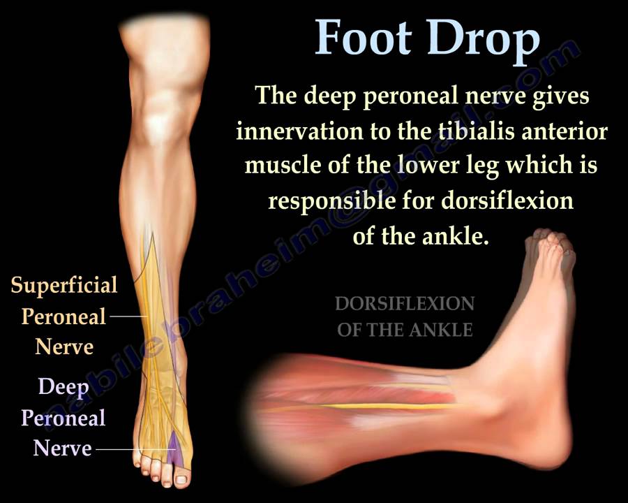 Foot Drop, Peroneal Nerve Injury - Everything You Need To Know - Dr