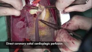 Surgical Correction of Ruptured Sinus of Valsalva Aneurysm in a Patient With Bicuspid Aortic Valve