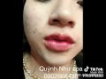 Tiêm môi xinh ngất ngay tại QUỲNH NHƯ BEAUTY & SPA