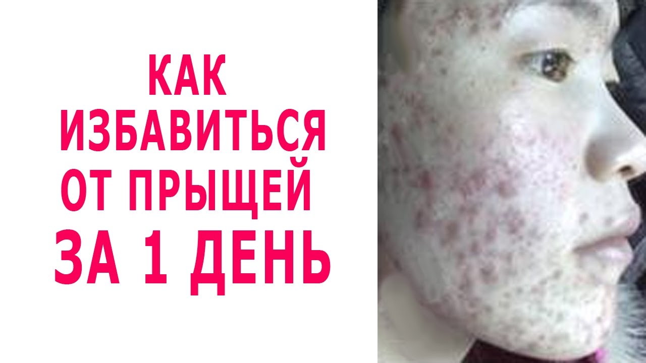 Избавляемся от прыщей за один день в домашних условиях 310