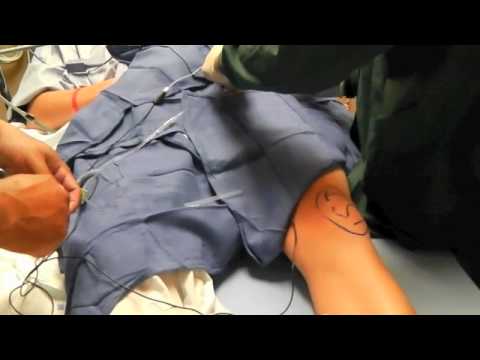 Total Knee Replacement - Femoral Nerve Block for Post Knee Surgery Pain