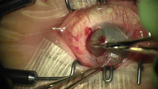 Corneal Scar Removal Superficial Keratectomy