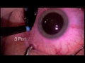 Vitrectomy for Vitreous Floaters (FOV)