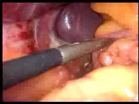 gastric bypass pill