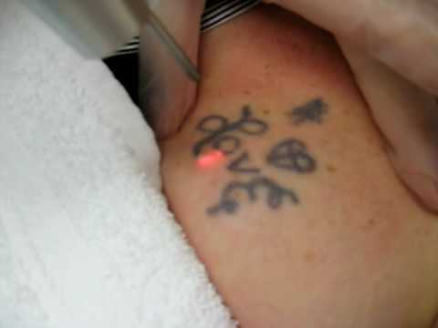 Tags:tattoo removal pain tattoo removal cost tattoo removal pricing how to remove a tattoo removing a tattoo ink removal removing ink remove tattoo 