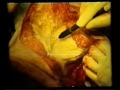 macromastia