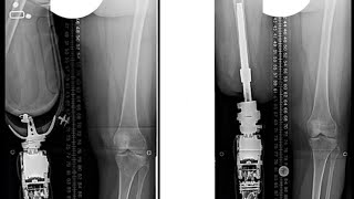 Osseointegration Surgery Vs. A New Prosthetic 🦿 #Oneleg #Rideordieamanda #Prosthetics #Surgery