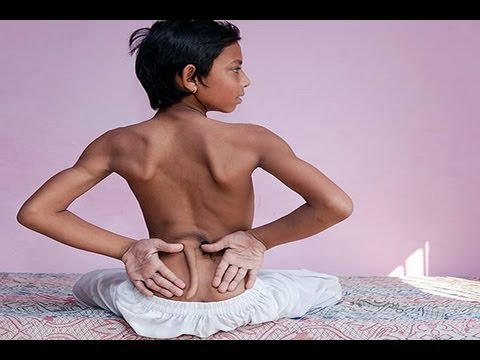 12 Yr Old Boy Born With A Tail - Indian God