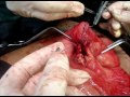 Anastomosis