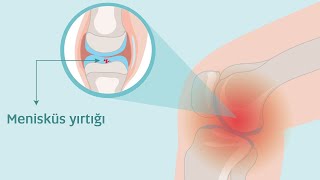 Menisküs Ameliyatı Sonrası İyileşme Süreci | Prof. Dr. Yakup YILDIRIM