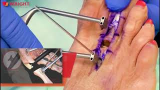 Gravity Plantar Plate Repair System Surgical Highlights And Tips And Tricks With Dr. James Sferra