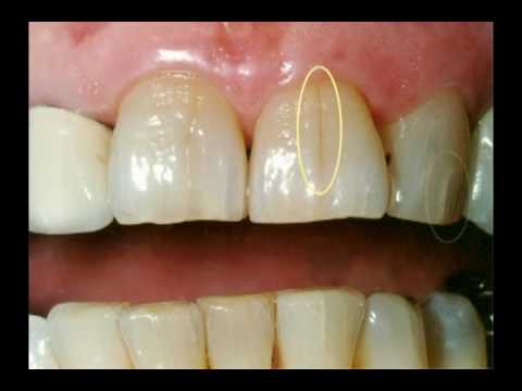 teeth translucent cracking