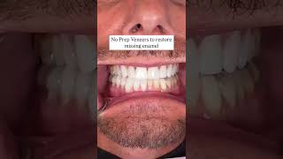 Restoring Lost Enamel And Balancing The Bite.