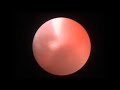 PERIANAL ABSCESS