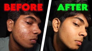 How To Fix Teenage Acne No Guide 2025