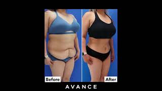 6-Month Abdominoplastytummy Tuck Result Avance Plastic Surgery Insute Dr. Erez Dayan