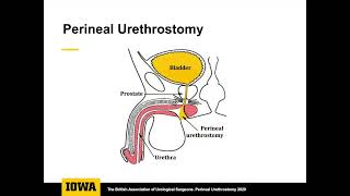 Core Videos 2021 Perineal Urethrostomy