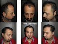 hair transplantation in India