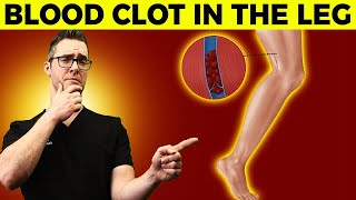 Blood Clot In The Leg? Early Signs, Symptoms, How To Check & Causes