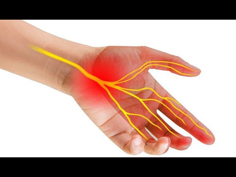 HỘI CHỨNG ỐNG CỔ TAY là bệnh gì và cách điều trị hiệu quả