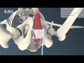 AMI ATOMS - Behandlung von Stress Harninkontinenz beim Mann / Blasenschwäche