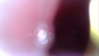Trying To See My Esophagus Part 3