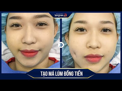 CẬN CẢNH quá trình tạo má lúm đồng tiền tại Kangnam
