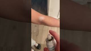 Benzocaine Spray For Rashes
