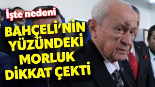 Oyunu kullandı: Devlet Bahçeli'nin yüzündeki morluklar dikkat çekti