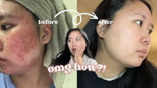 How I got Clear Skin by doing NOTHING!