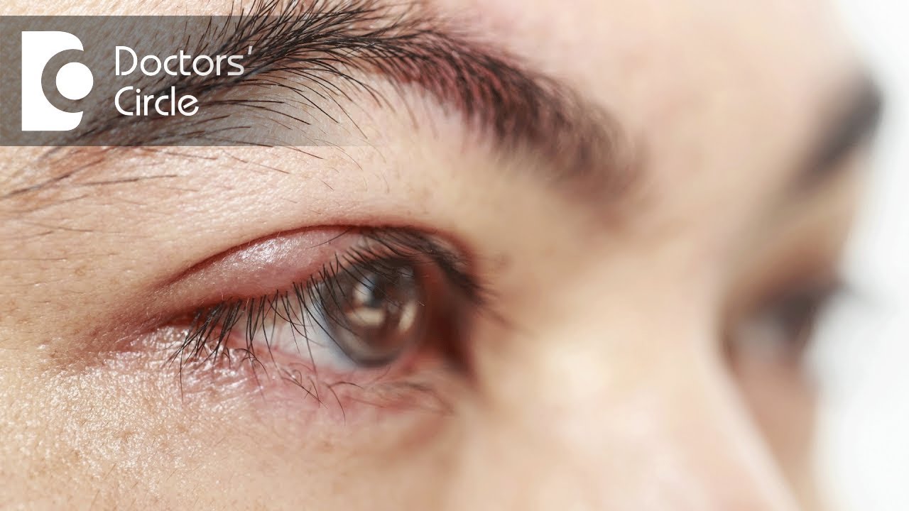 Do Swollen Itchy Burning Eyes Indicates Blepharitis Dr Sunita Do Swollen Itchy Burning Eyes Indicates Blepharitis Dr Sunita Rana Agarwal