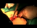 Hysterectomy: Surgical removal of the uterus
