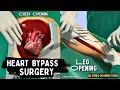 Heart Bypass Surgery ' 3D Video In  हिन्द/اردو