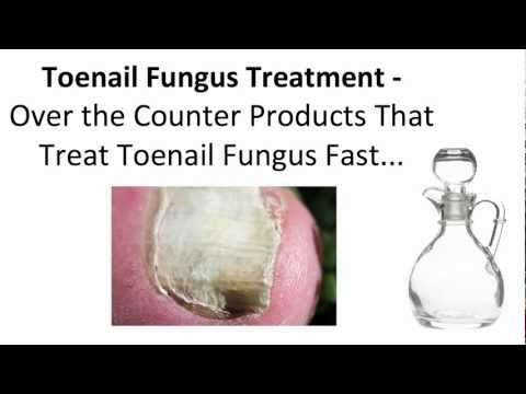 Toenail Fungus Treatment - Over the Counter Products That Treat Toenail